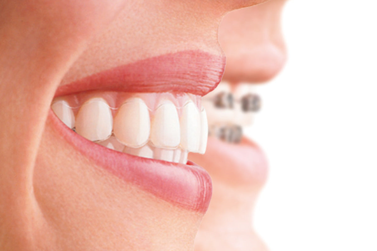 Which Invisalign Brace is Best for You?