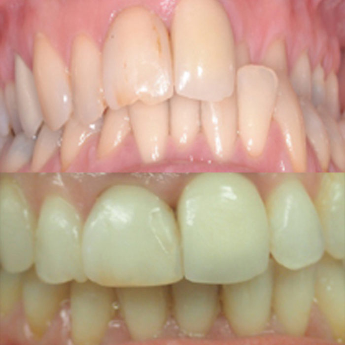 Crossbite - before and after orthodontic treatment